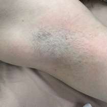 Депиляция, в Пензе