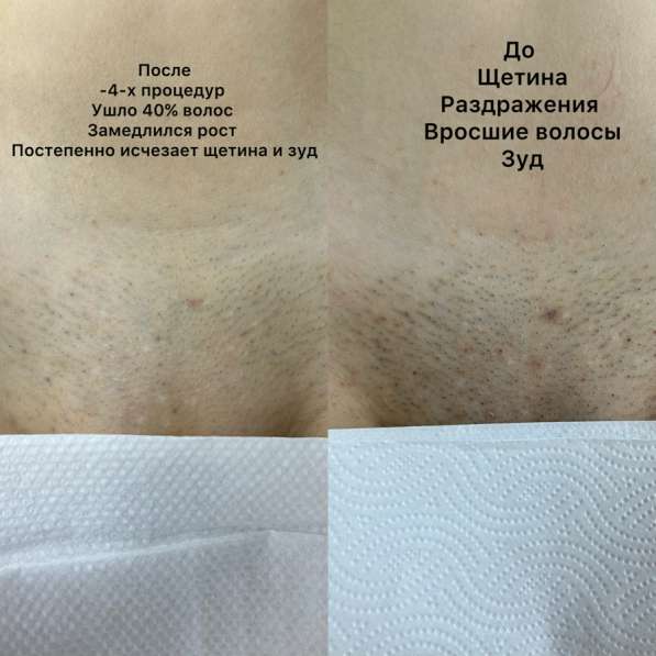 Лазерная эпиляция в Гуково фото 5