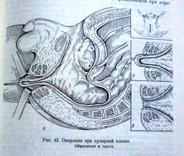 Продам русскую книгу "Хирургия толстой кишки у детей" 1974г в Юрге фото 5
