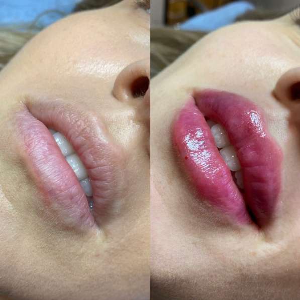 Увеличение губ в Мытищи фото 4