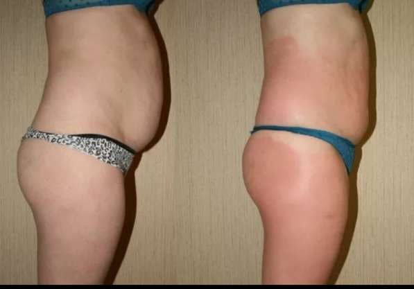 Антицеллюлитный массаж