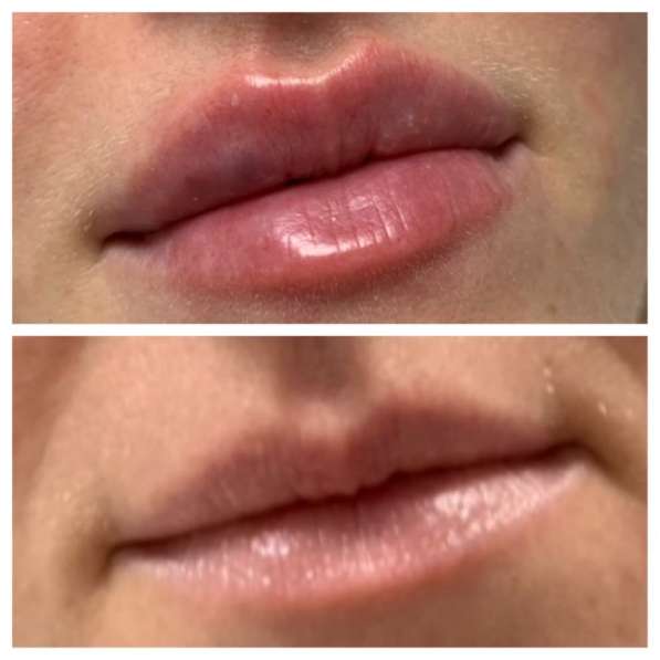 Увеличение губ в Мытищи фото 7