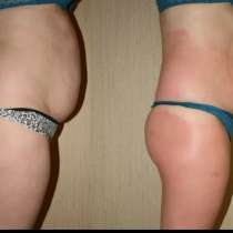 Антицеллюлитный массаж, в Краснодаре